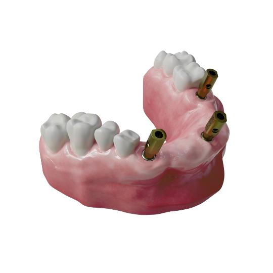 one-piece-scanbody-no-pins