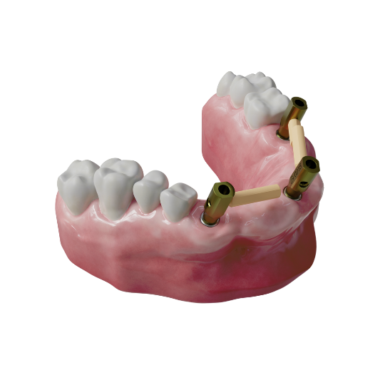 one-piece-scanbody-with-pins